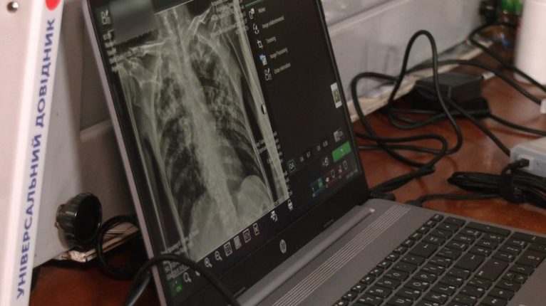 На Франківщині у 2023 році зросла кількість хворих на туберкульоз